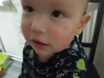 Ребенок два года, не понимаю на что аллергия фото 1