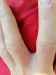 Покраснение, шелушение между пальцами и ладони рук фото 1