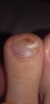 Повреждение или грибок ногтя фото 1