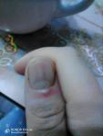 Полоски под ногтем, нарывает палец фото 2