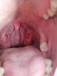 Увеличены миндалины, болит горло фото 2