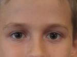 Разный размер глаз у ребенка фото 1