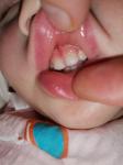 Пятна на детских зубах фото 3