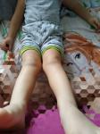 Х- образные ножки у мал 2,5 года. Нужен ли массаж фото 2