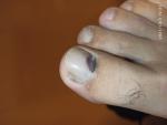 Рак ногтя на правой ноге фото 2