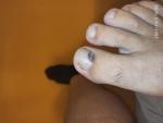 Рак ногтя на правой ноге фото 3