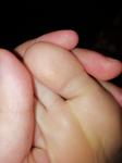 Образование на пальце ноги у ребенка фото 2