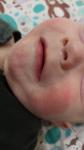 Сыпь у ребенка на щеках 5м фото 1