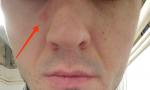 Покраснение и шелушение возле носа фото 2