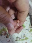 Отросточек на пальце у новорождённой фото 1