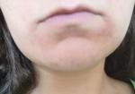 Красные шелушащиеся пятна в области уголков губ фото 1