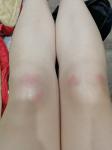 Горячие больные красные шишки на коленях фото 3