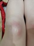 Горячие больные красные шишки на коленях фото 2