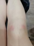 Горячие больные красные шишки на коленях фото 1