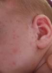 Сыпь на лице у новорожденного фото 2