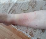 Покраснение на ноге с трещинами на коже. Небольшая температура фото 1
