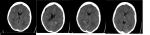 КТ мозга белые точки фото 1