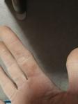 Потемнение кожи на пальце руки фото 1