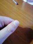 Проблема с ногтями после приема витаминов Компливит фото 2