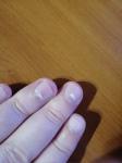 Проблема с ногтями после приема витаминов Компливит фото 3