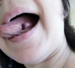 Кровяные шарики под языком с бусинку фото 1
