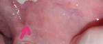 Красное пятно на слизистой щеки 1 месяц фото 2