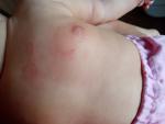 Сыпь у ребенка на руке, что это за кожное высыпание фото 1