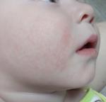 Высыпание на лице ребенка без шелушения фото 1