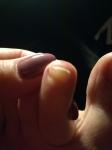 Уплотнение ногтя на ноге фото 1