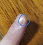 Белое, болезненное уплотнение возле ногтя пальца фото 1