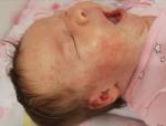 Акне или аллергия у новорожденного фото 1