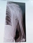 Перелом хирургической шейки плечевой кости фото 1