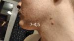 Коричневое пятно на лице в районе нижней челюсти фото 1