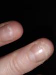 Грибок ногтей рук фото 2