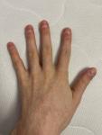 Ногти Гиппократа фото 3