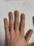 Ногти Гиппократа фото 1