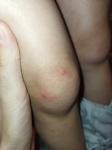 Красная сыпь на коленях у ребенка фото 2