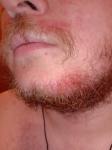 Зуд и шелушение кожи в области бороды и усов фото 1