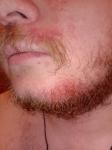 Зуд и шелушение кожи в области бороды и усов фото 2