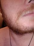 Зуд и шелушение кожи в области бороды и усов фото 3