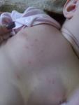 Сыпь на груди у ребенка фото 2