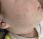 Сыпь на лице у младенца фото 1