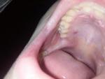 Вискочив горбик у роті фото 1