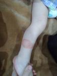 Страшные высыпания на ногах ребенку 1.5 фото 3