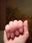 Розовые образования на пальцах, фото прилагаю фото 4