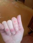 Розовые образования на пальцах, фото прилагаю фото 2