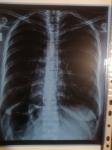 Рентген грудной клетки и температура фото 1