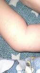 Аллергическая сыпь у ребенка 1.3 года фото 1