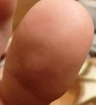 Подкожные волдырики на пальце ноги фото 2