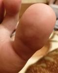 Подкожные волдырики на пальце ноги фото 1